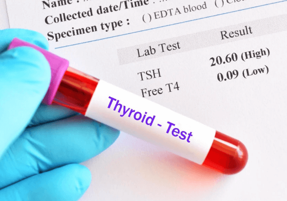 Thyroid Function Test